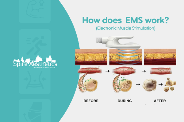 EMS treatment for post pregnancy weight loss treatment Dunchurch