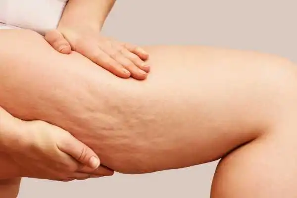 Image of woman showing leg with cellulite Dunchurch