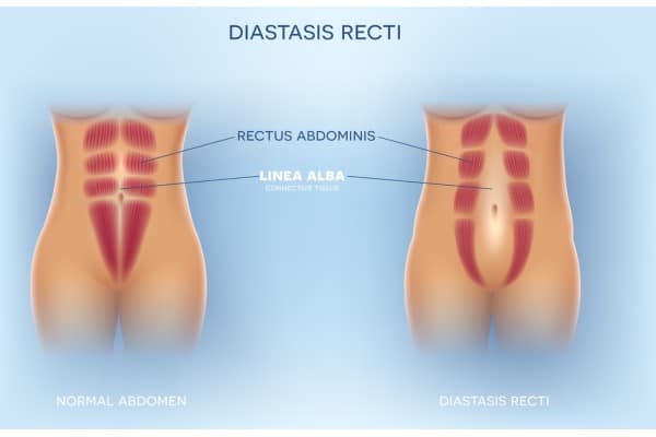What Non-Surgical Options Are Available for Diastasis Recti Dunchurch?