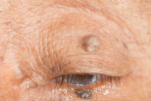 Skin imperfections Dunchurch - Cryopen is fast and effective book in today!