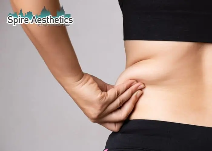Image of woman pinching fat on their hips Dunchurch. Fat Freezing treatment