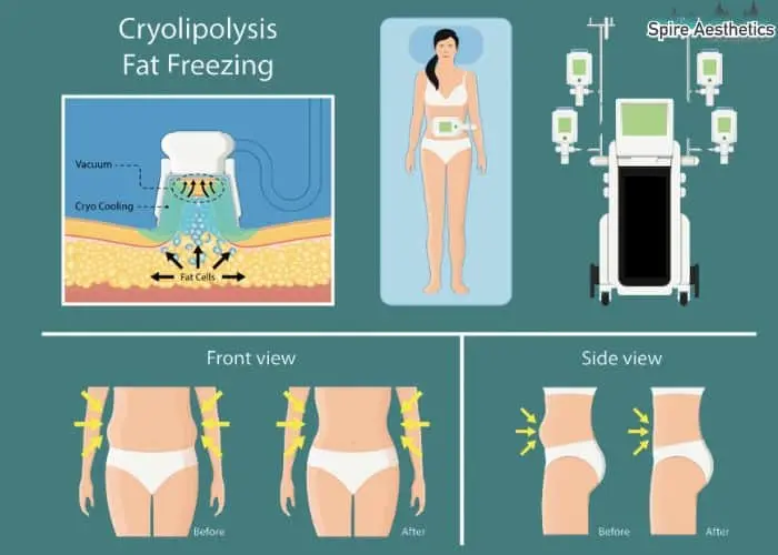 Fat freezing treatment Dunchurch benefits for competitions to remove stubborn fat deposits.