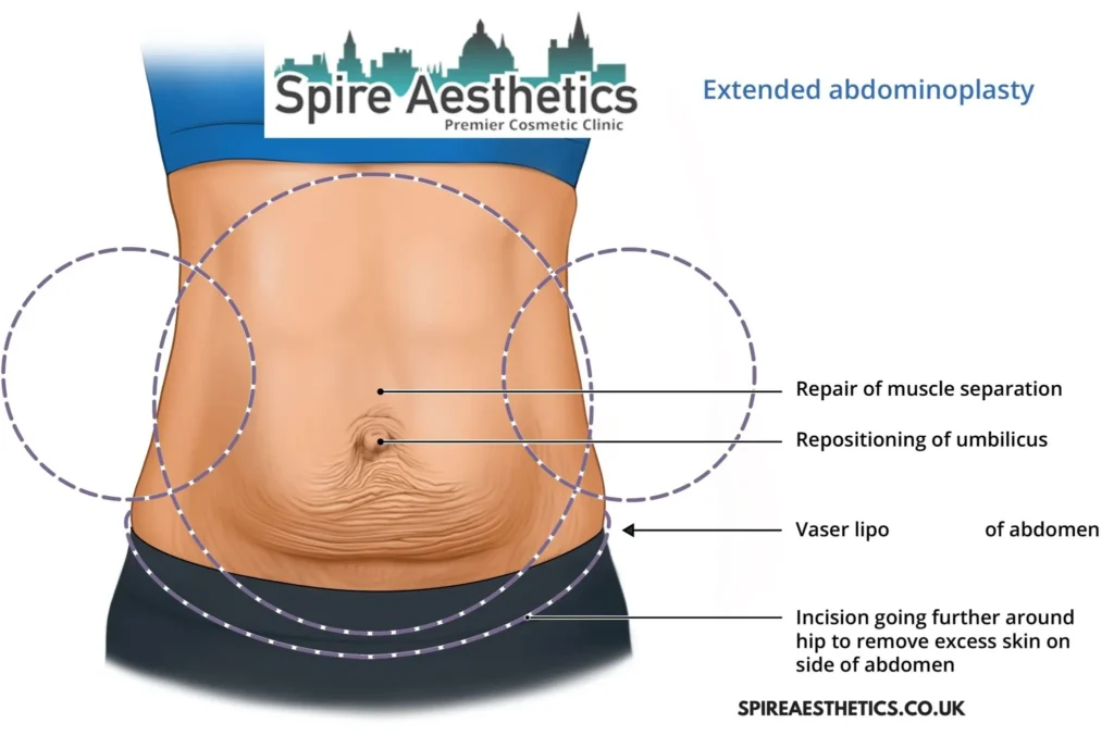 Understanding Loose Skin After Gastric Band Dunchurch Surgery and HIFU Treatment 