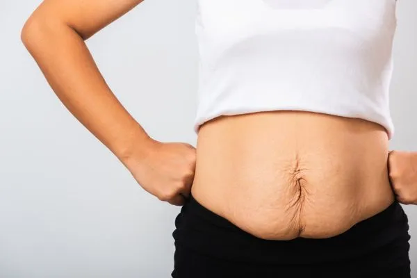 Image of a woman's stomach after weight loss with sagging skin following a gastric band Dunchurch