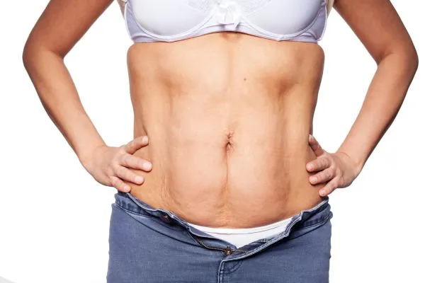 sagging skin on woman's stomach after weight loss injections Dunchurch