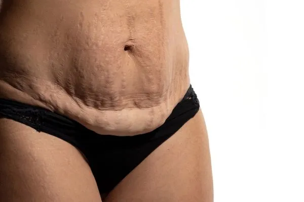 Image of womans stomach after weight loss injections Dunchurch showing saggy skin