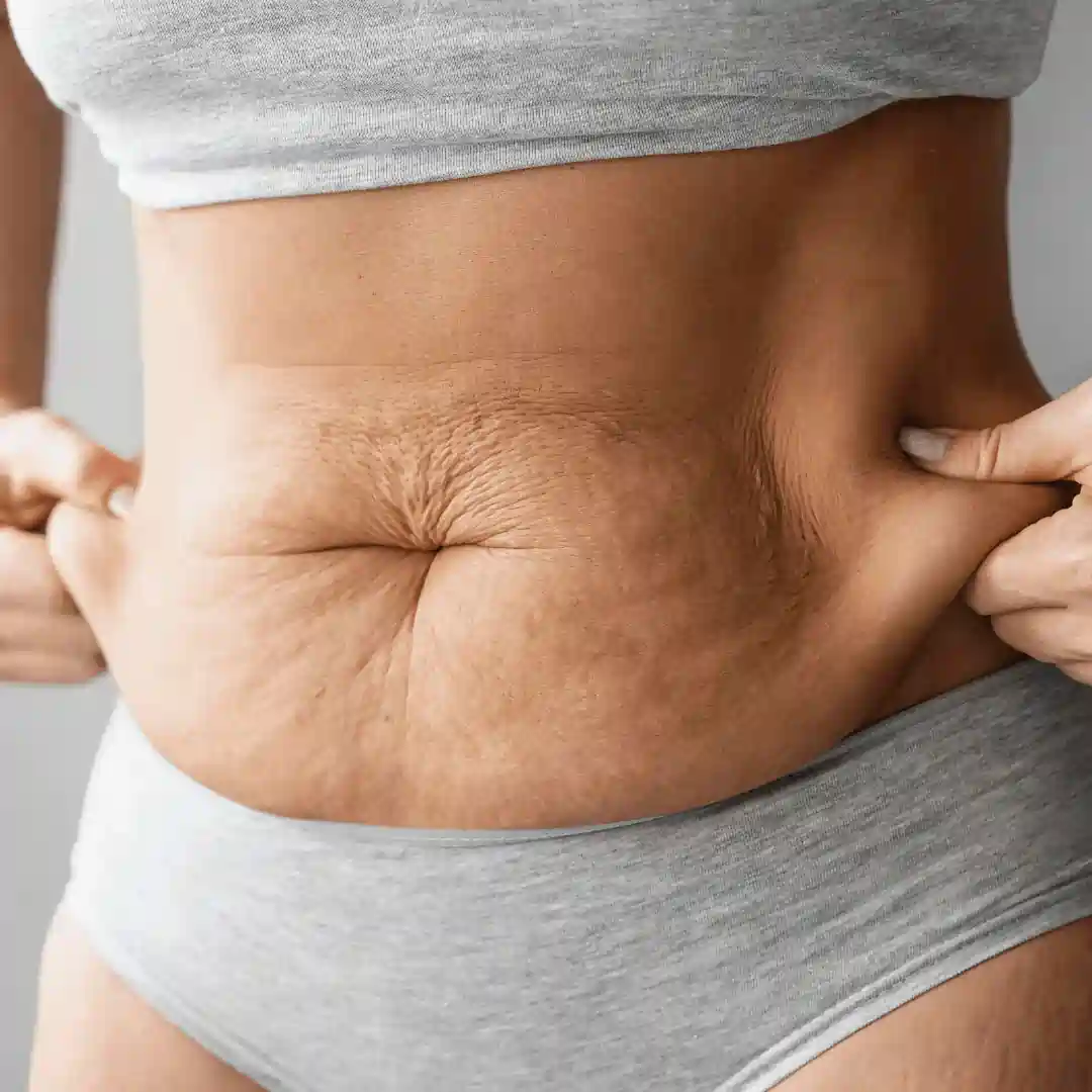Is It Normal to Have Loose Skin After Pregnancy Dunchurch?