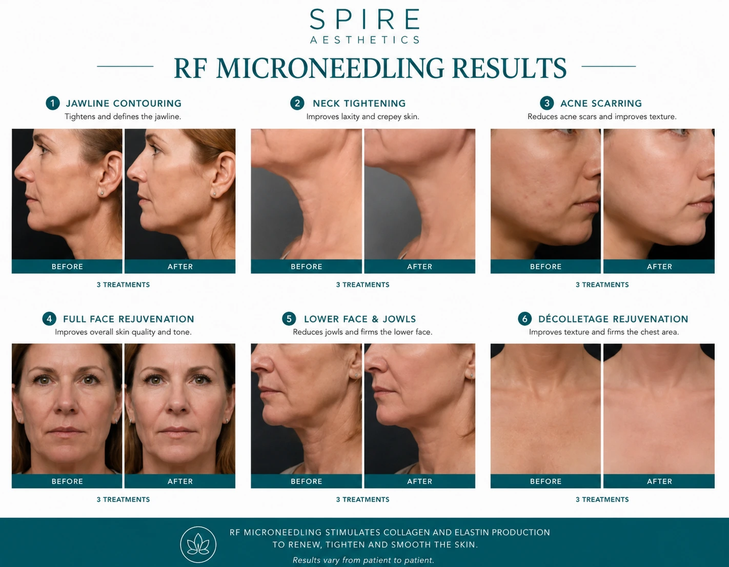 RF Microneedling Skin tightening Dunchurch results