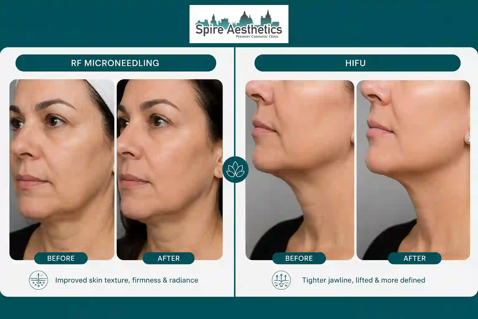 Can RF Microneedling and HIFU Be Combined Dunchurch?