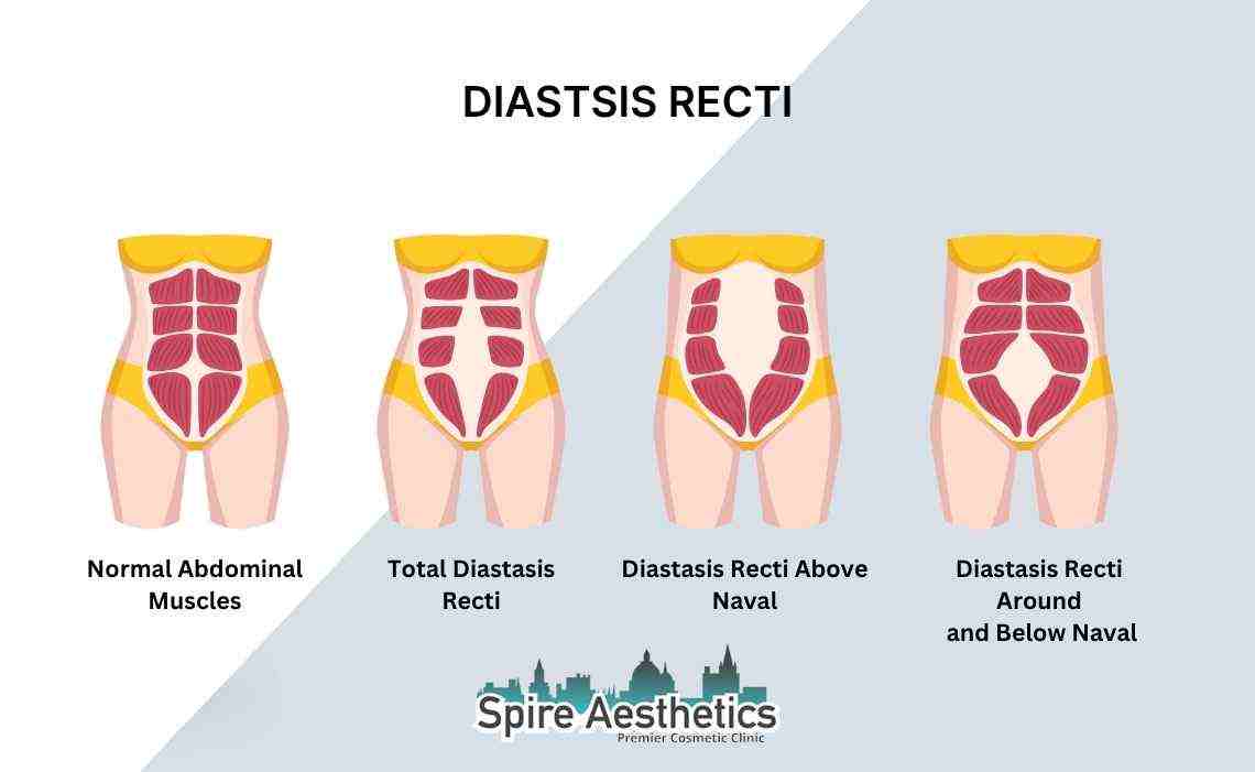 Is Non-Surgical Diastasis Recti Treatment Right for You? Common Concerns Answered Dunchurch